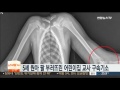 5세 원아 팔 부러뜨린 어린이집 교사 구속기소 연합뉴스tv yonhapnewstv