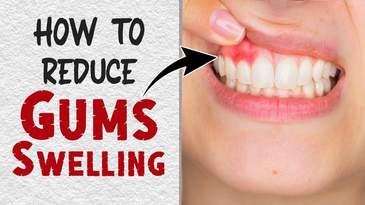 How To Reduce Gum Pain At Evelyn Turner Blog