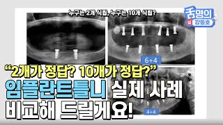 임플란트틀니 실제사례 임플란트개수 차이나는 이유는?