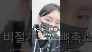 비절개광대뼈축소 수술 후 4일째 외출