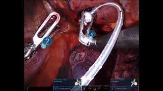 Dr. David Cable- daVinci Minimally Invasive Epicardial Lead Placement