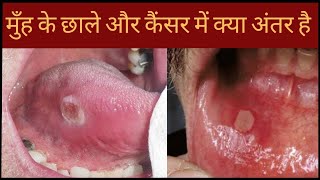 मुँह के छाले और कैंसर में क्या अंतर है | Mooh Ke Chhalle Aur Cancer Mein Kya Antar Hai