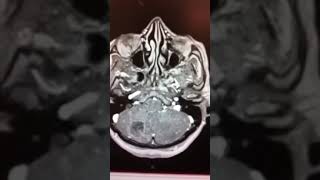 RESSONÂNCIA DE ENCÉFALO: METÁSTASE CEREBRAL