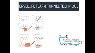 ENVELOPE TECHNIQUE| POUCH \u0026 TUNNEL TECHNIQUE| SUBMERGED GRAFTS| ROOT COVERAGE| DR. ANKITA KOTECHA