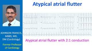 Atypical atrial flutter