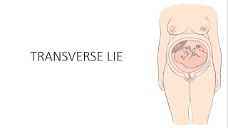 Transverse Lie - Causes, Diagnosis, Management by Obstetrics Made Non-Toxic