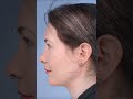 Midline Neck Lift with Facetite and a Chin Implant from Drs. Lieberman and Parikh