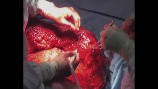 Incisional Hernia Repair with Retrorectus Synthetic Mesh and Abdominoplasty