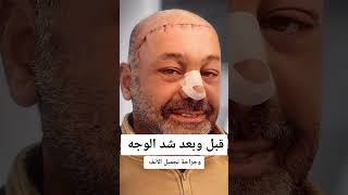 عمليه شد الوجه وتجميل الانف | النتيجة قبل وبعد صدمة 🙀