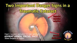 CataractCoach.com guest surgeon Ashraf Armia MD with traumatic cataract