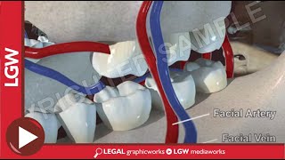 Reconstructive surgery of the maxilla using free fibula flap 3D animation