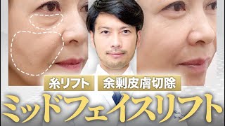 本当のミッドフェイスリフト(BIANCA CLINIC)