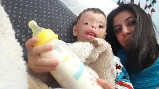 Burned toddler's future waits on Trump's ban