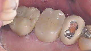 Retreatment of failing root canal treatment.