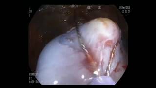 Combined Endo-laparoscopic Surgery for Colon Polyp