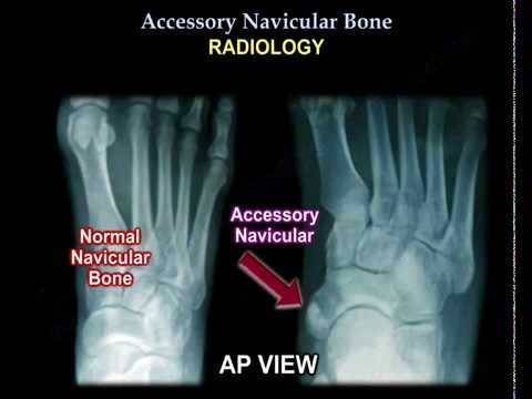Is accessory navicular bone hereditary?