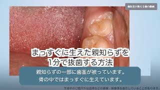 まっすぐに生えた親知らずを1分で抜歯する方法