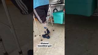 bilateral transtibial gait #amputee #prosthesis #bilateralamputee