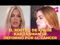 Khloé Kardashian mostró cómo el cáncer le deformó parte del rostro