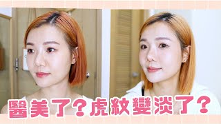 我做醫美了? 自生膠原有用嗎? ft: JULAINE膠原再生療程