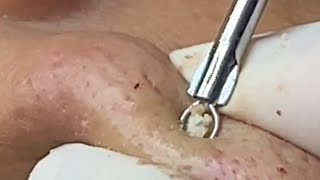 Epic Nose Squeeze And Blackhead Removal