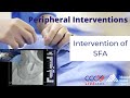 Intervention of SFA - May 22, 2013 Live Case Video