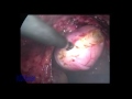 Laparoscopic Enterocele suspension by Dr Pragnesh shah Motera Ahmedabadd