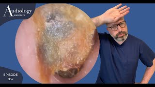 DEEP, DRY \u0026 DIFFICULT EAR WAX REMOVAL- EP837