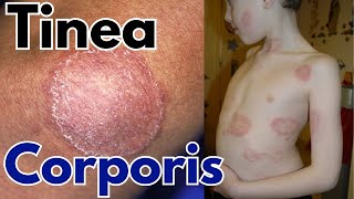 Tinea corporis infection |  Ring worm symptoms, treatment and causes