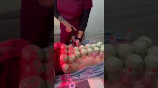 Chiropractic Adjustment +Acupuncture + Cupping Therapy! Part 2
