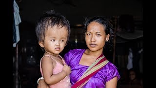 Mother Fears For Toddler With Extraordinary Large Head