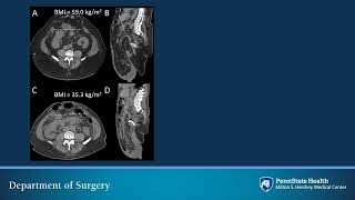 Laparoscopic Sleeve Gastrectomy in Patients with Complex Abdominal Wall Hernias