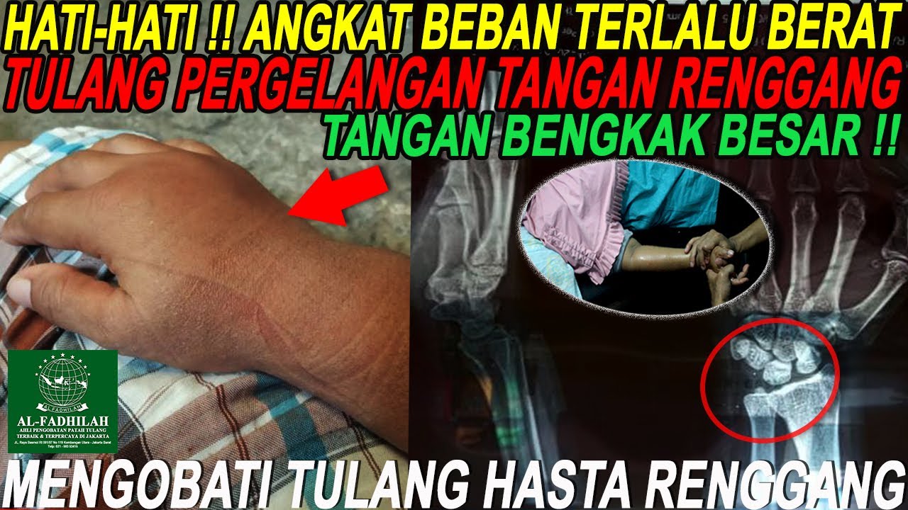 BENGKAK !! CEDERA TULANG PERGELANGAN TANGAN RENGGANG (ULNA SPRAIN ...