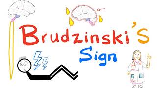 Brudzinski's Sign | Meningitis | Neurology | Physical Exam