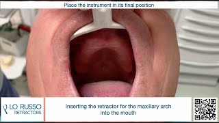 LO RUSSO RETRACTORS - inserting the instrument for the maxillary arch into the mouth