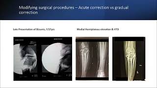 Pediatric limb reconstruction in a resource-challenged environment - Anirejuoritse Bafor MBBS