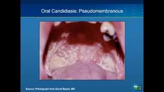 Oral Manifestations of HIV: Case Studies