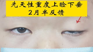 还记得这个12岁的陕西小帅哥吗？先天性重度上睑下垂术后2月半