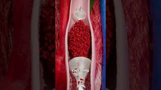 Removing Blood Clots with Vacuum 😨