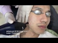 Advanced ECO2 Fractional Laser Treatment