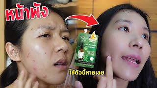 สิวบุกเต็มหน้าใช้  Plantnery tea tree สิวหายถายใน​ 7​ วัน