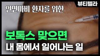 안면마비 환자에게 보톡스 치료가 필요한 이유 (안면마비 보톡스 치료 1부)