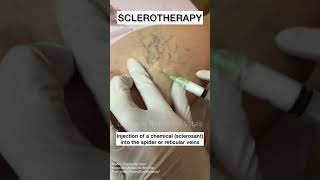 Sclerotherapy for Spider and Varicose Veins #Shorts