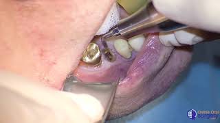 Ankylosed Tooth Extraction Using the Piezotome® CUBE