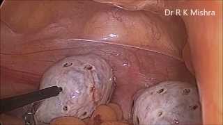 Diagnostic Laparoscopy Tubal Patency Test and Ovarian Drilling