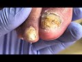 super long video on trimming thick nails so decompressed 【podiatry clinic】