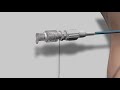 single step locking pigtail drainage catheter gta s.r.l.