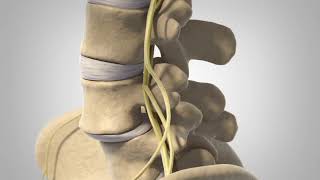 ခါးရိုးအရှေ့ရွေ့ခါးနာခြင်း Spondylolisthesis