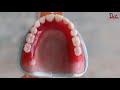 prosthodontics class three teeth arrangement made easy