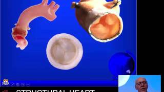 Pulmonary valve replacement: who & how - Prof Richard Chard